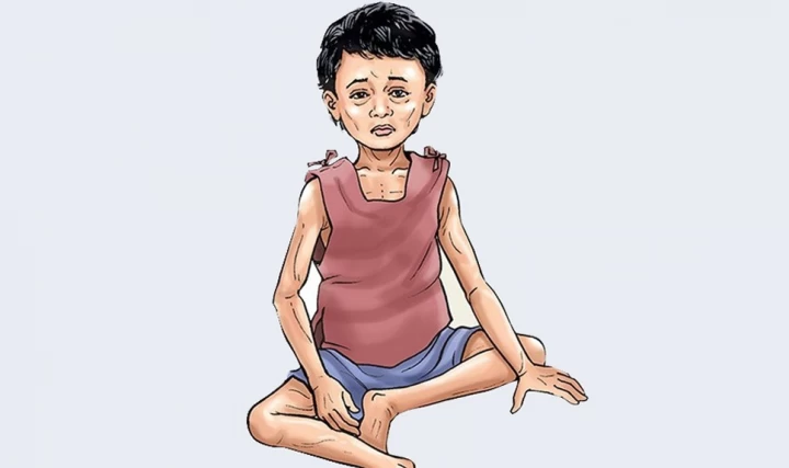 पाकिस्तानमा कुपोषणबाट १७ लाख बालबालिकाको मृत्यु